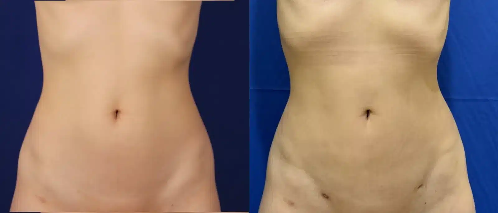 Liposuction body contouring before and after, front view &mdash; Patient 10