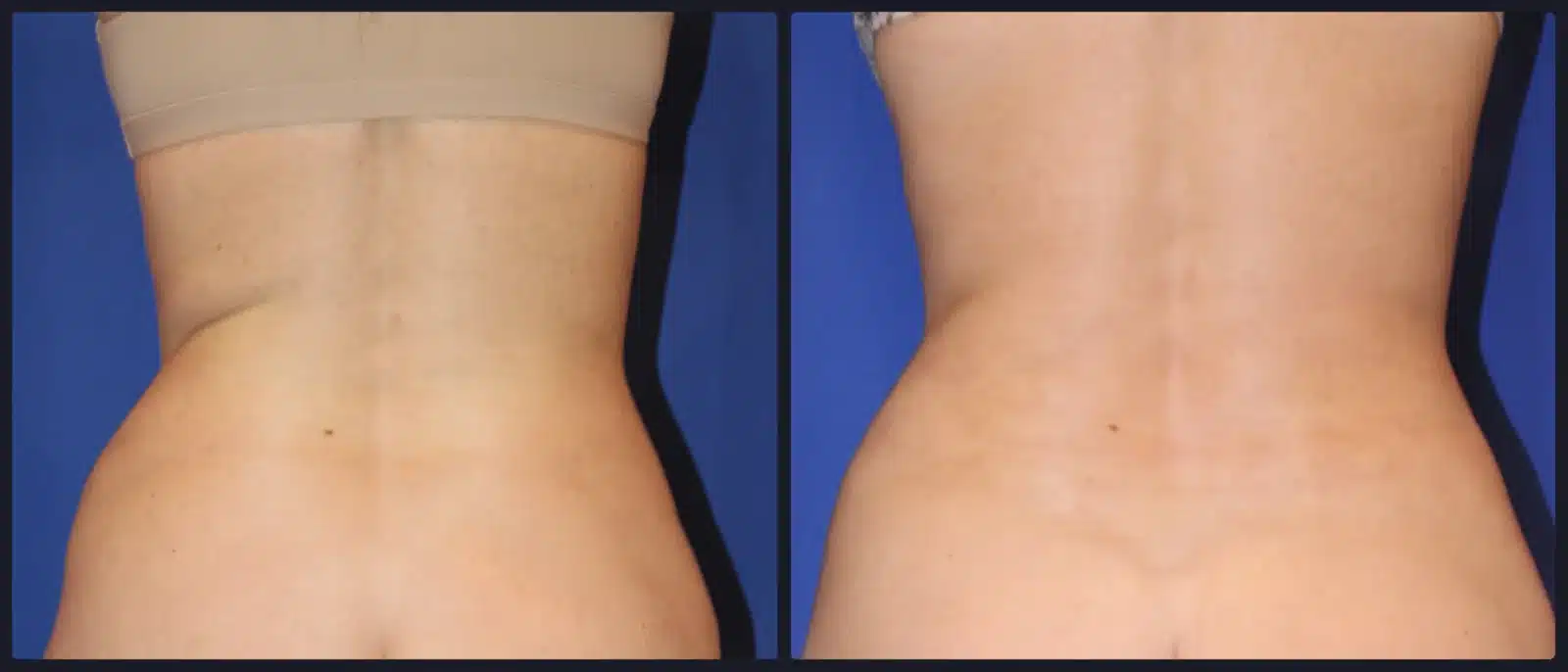 Liposuction body contouring before and after, rear view &mdash; Patient 4