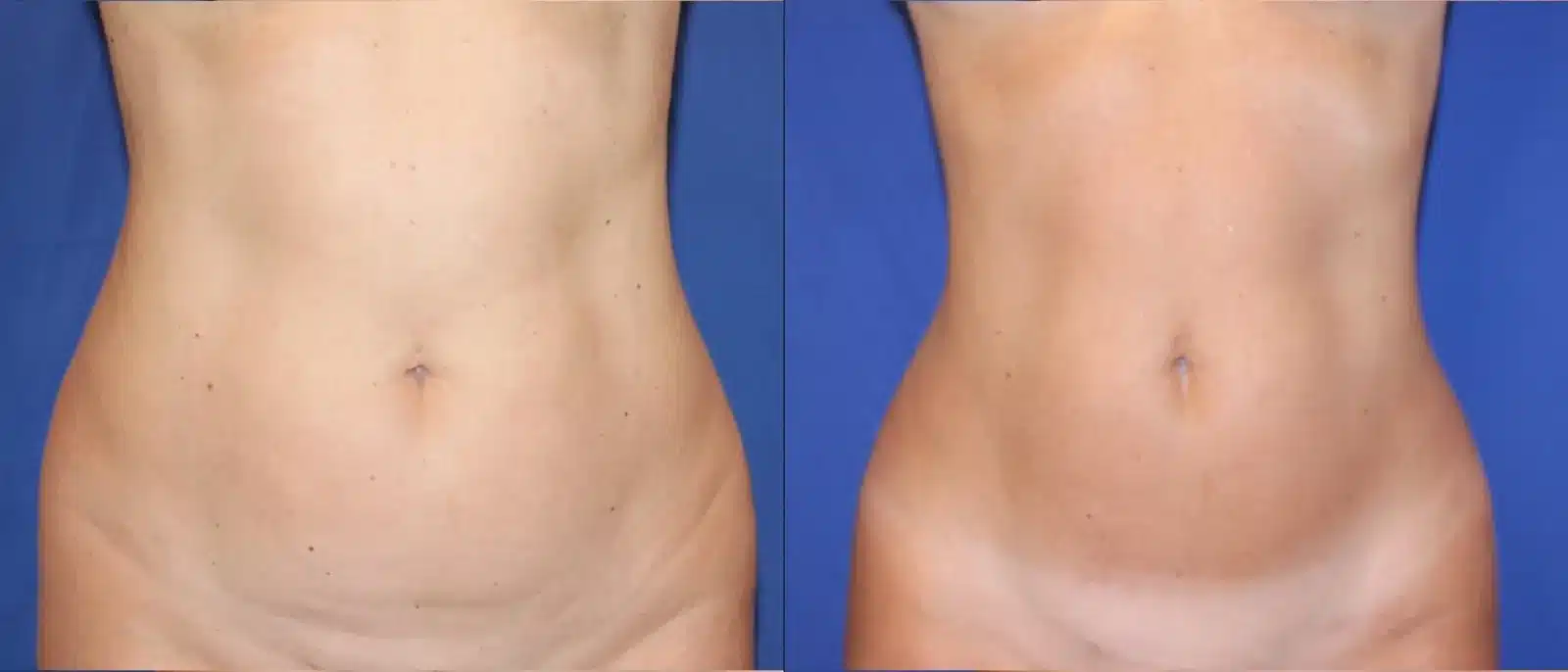 Liposuction body contouring before and after, front view &mdash; Patient 9
