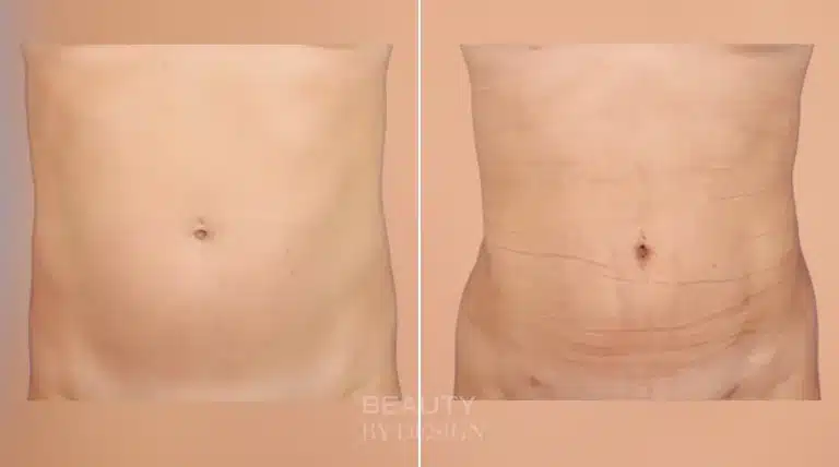 Liposuction body contouring before and after, front view &mdash; Patient 13