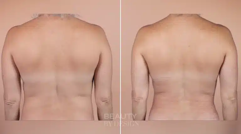 Liposuction body contouring before and after, upper back &mdash; Patient 14