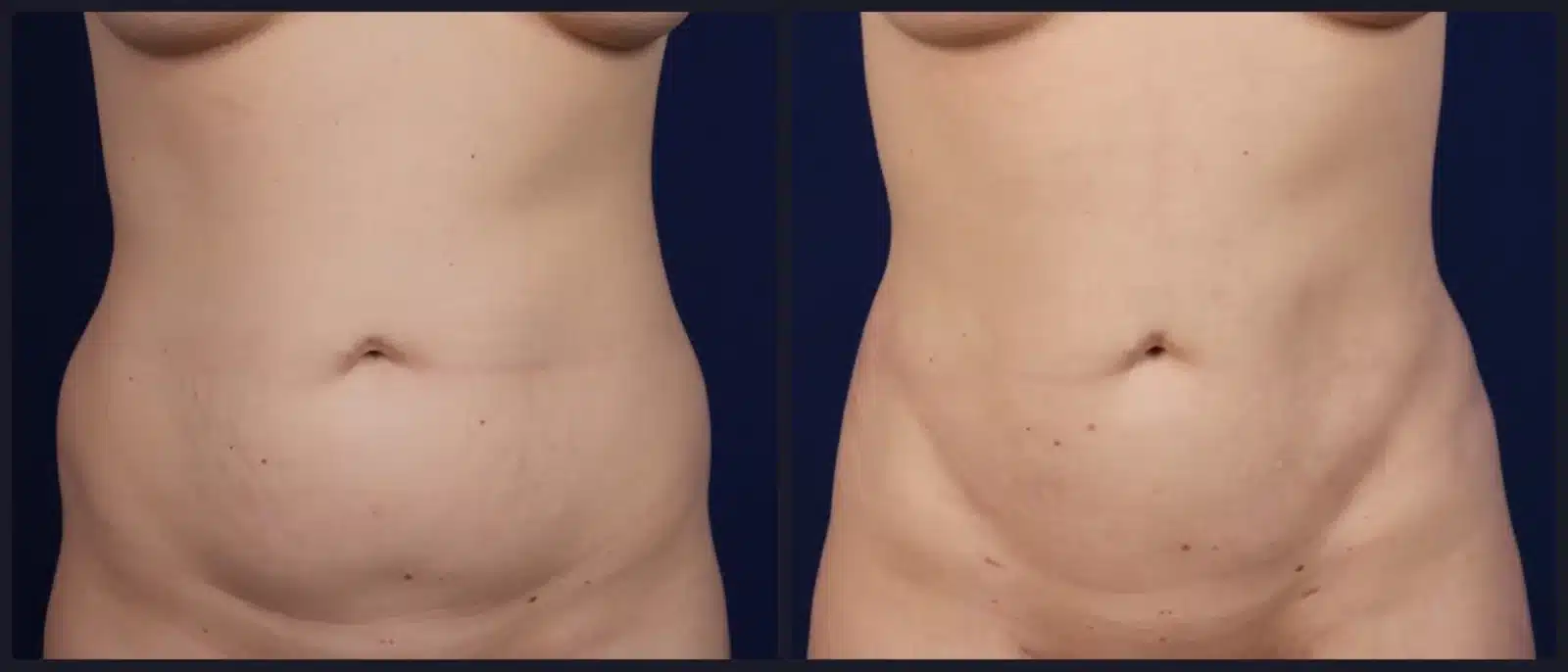 Body contouring before and after, front view &mdash; the waist is narrower and more defined after liposuction by Dr. Robert J. Troell in Las Vegas