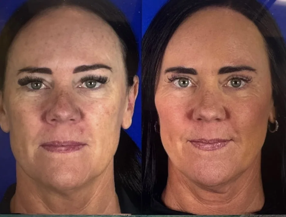 Before and after midface implant with blepharoplasty, front view &mdash; restored midface volume and a rested peri-orbital appearance. Actual patient in Las Vegas; individual results vary