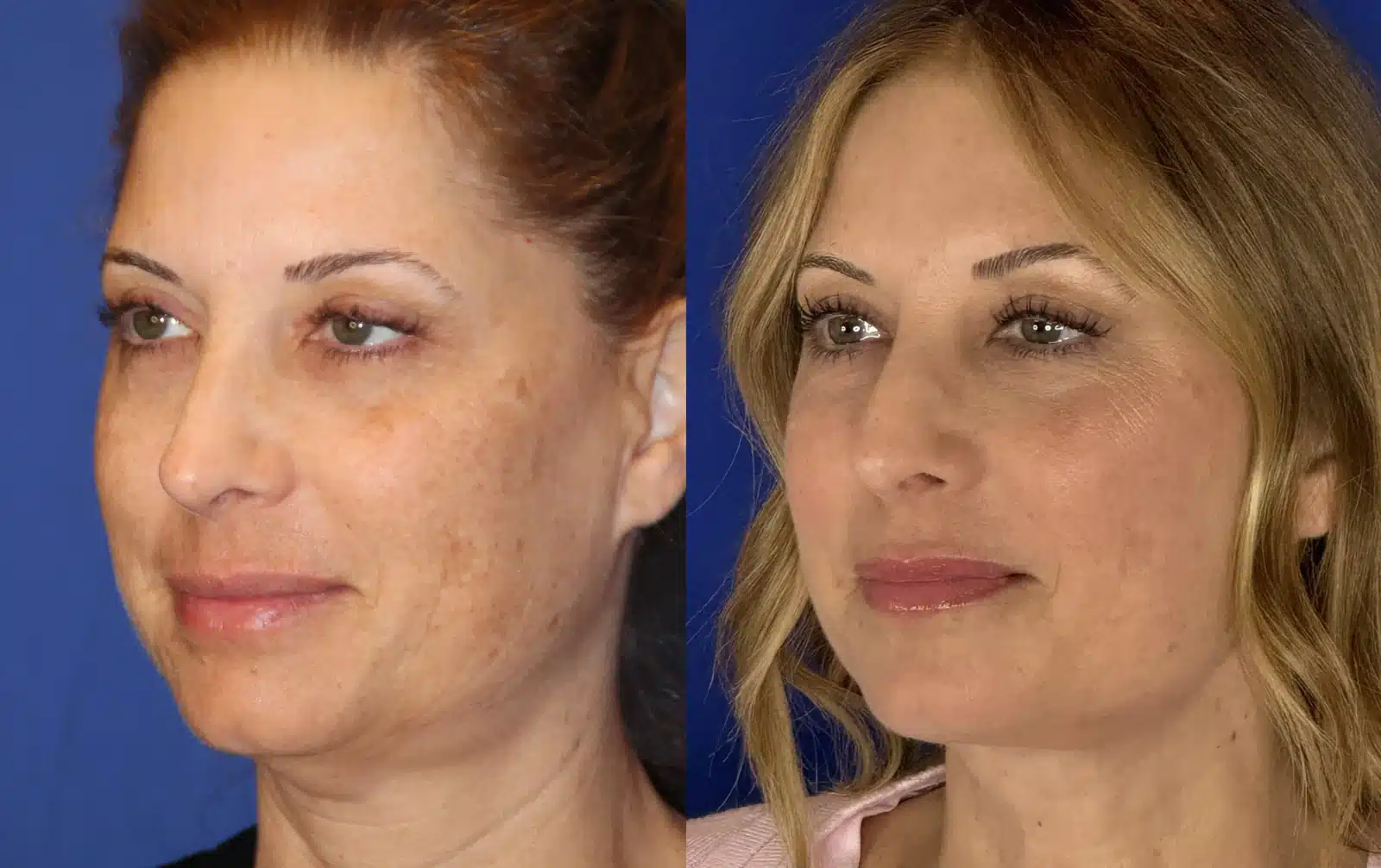 Neck lift before & after, left three-quarter view &mdash; Patient 10 &mdash; Neck Lift