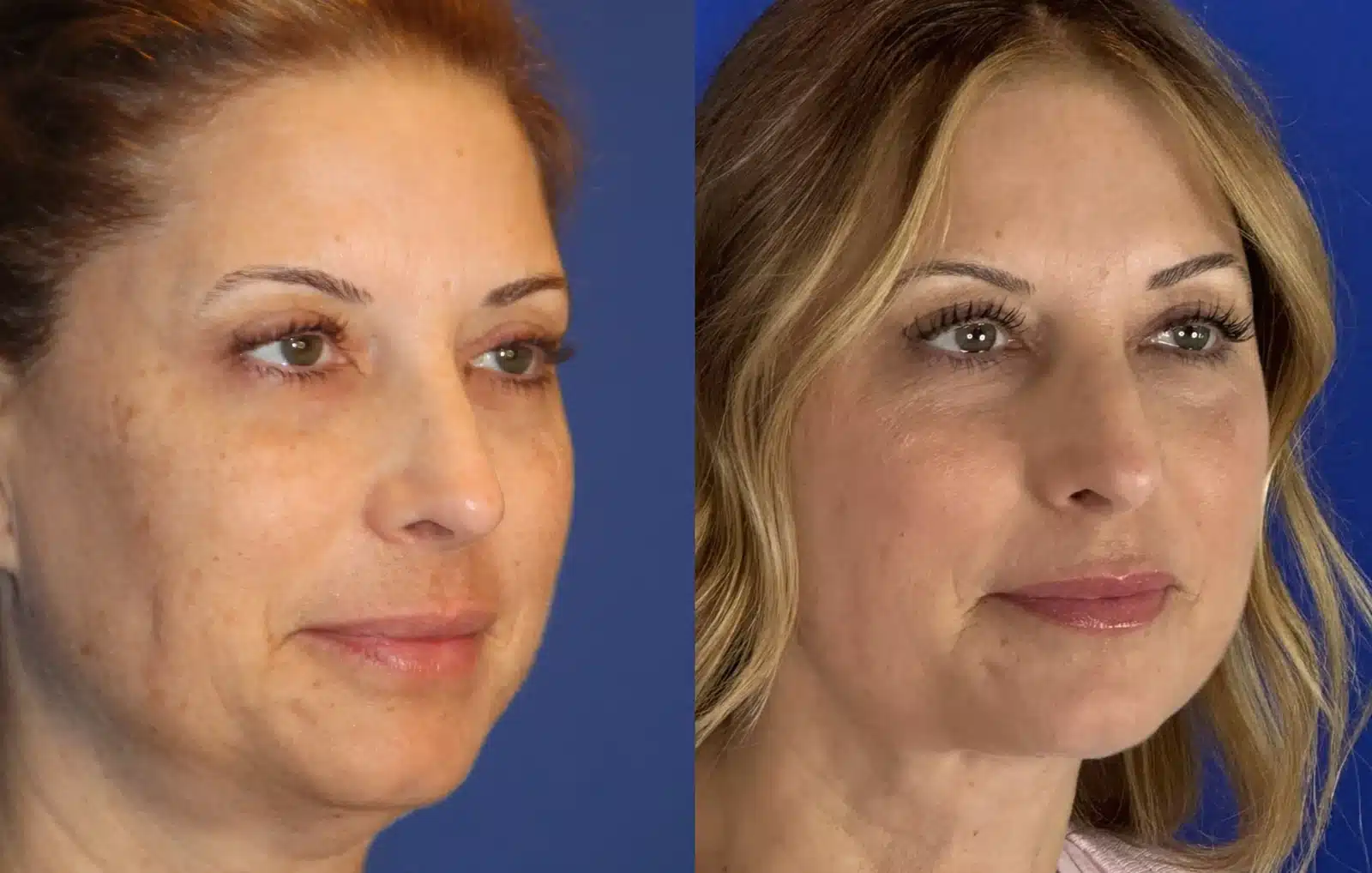 Neck lift before & after, right three-quarter view &mdash; Patient 10 &mdash; Neck Lift