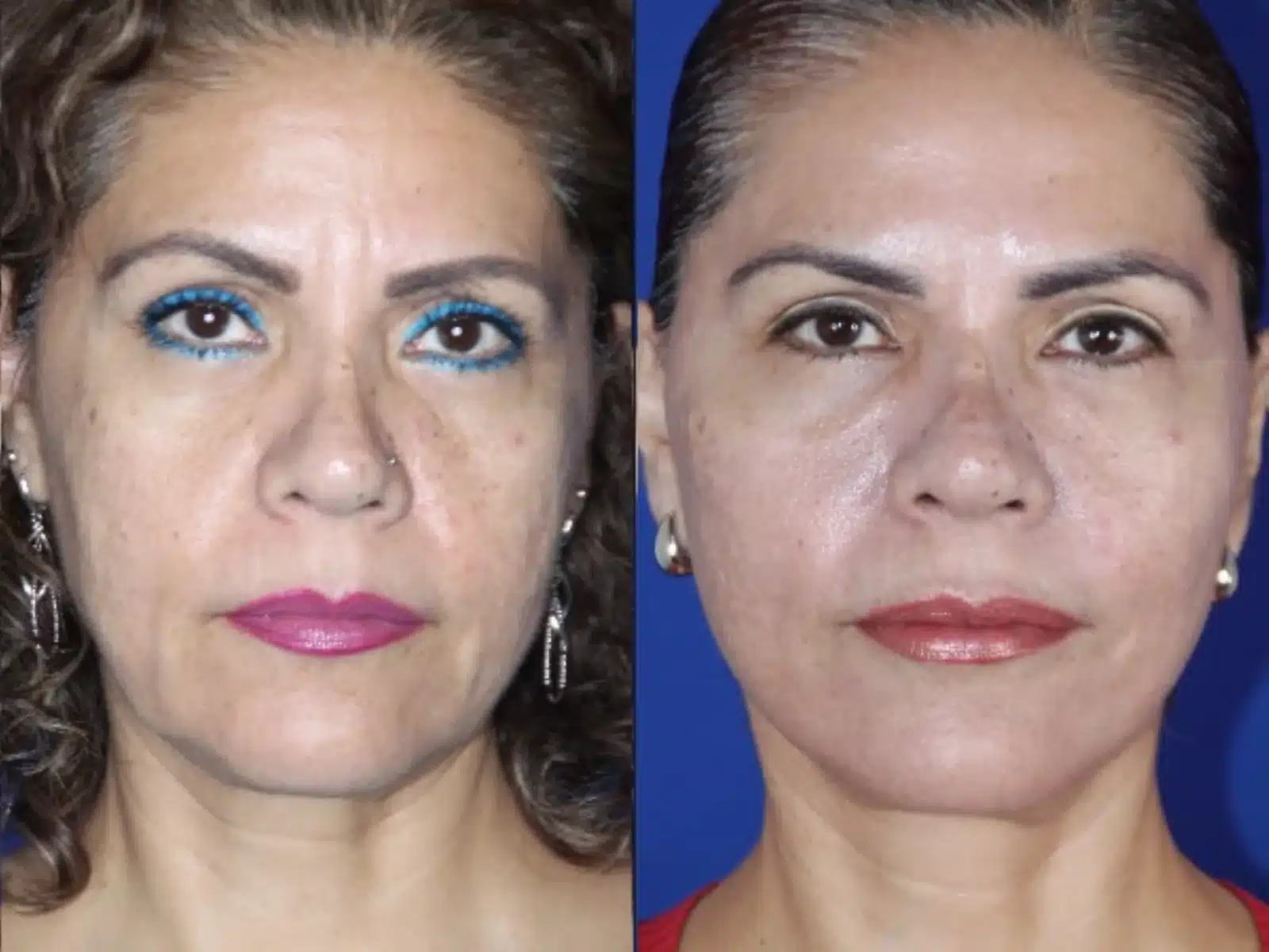 Submalar cheek implants before and after, front view &mdash; a woman's flattened midface below the cheekbones regains volume and a smoother cheek contour after submalar implant placement performed with a facelift and neck lift by Dr. Robert J. Troell in Las Vegas. Actual patient; individual results vary.
