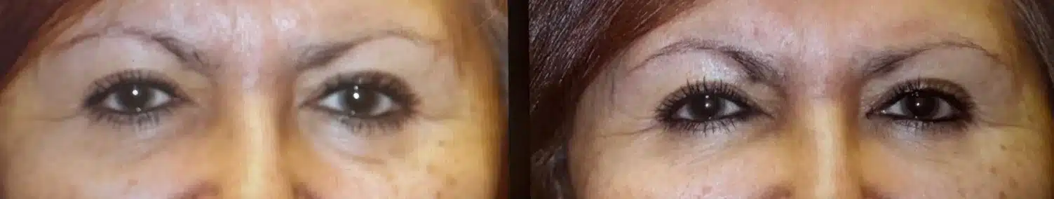 Before and after tear trough fat grafting, close-up front view: the under-eye valley restored &mdash; actual patient, Las Vegas