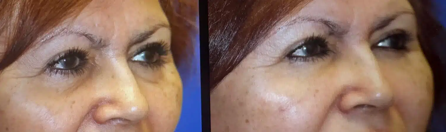 Before and after tear trough fat grafting, close-up oblique view &mdash; actual patient, Las Vegas