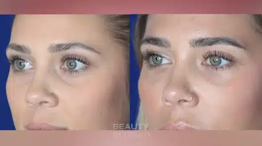 Tear Trough Fat Grafting: Natural Under-Eye Fix | Dr. Troell