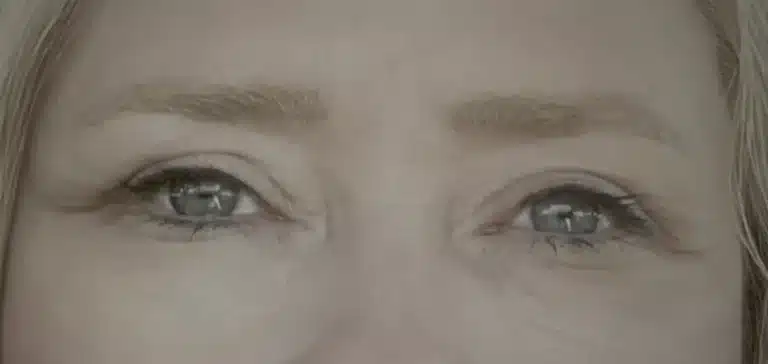 Eyelid Surgery for Tired Eyes: Does It Really Work?