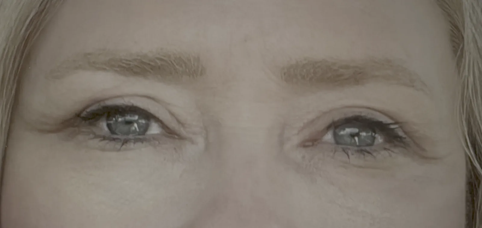 Eyelid Surgery for Tired Eyes: Does It Really Work?
