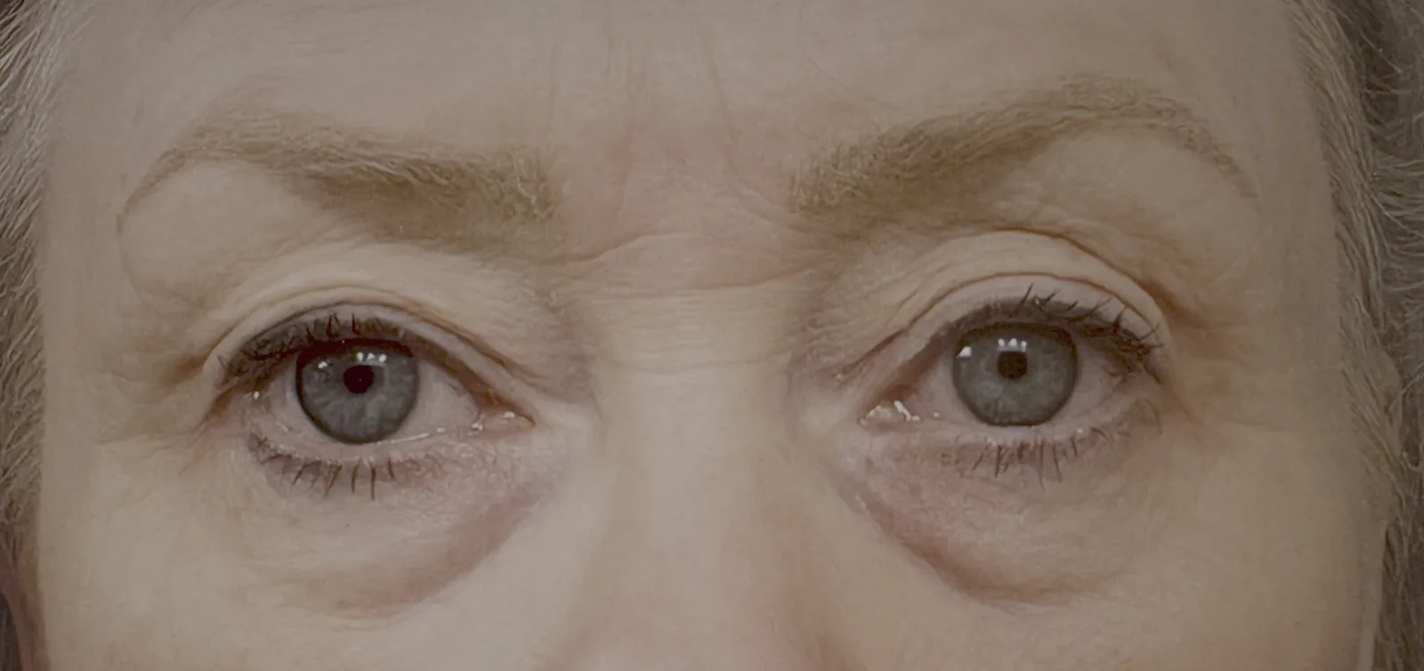 Before close-up &mdash; hooded upper eyelids and tear-trough hollows giving a tired appearance, prior to upper eyelid surgery, browlift, tear-trough Bellafill, and laser in Las Vegas