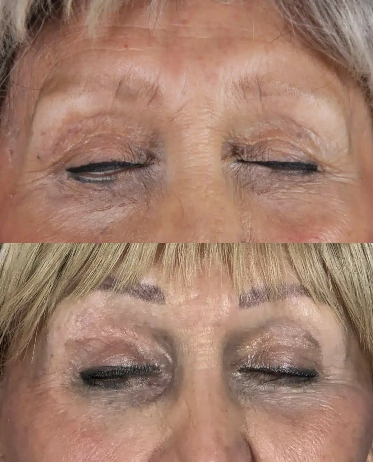 Upper blepharoplasty before & after, eyes closed &mdash; Patient 16 &mdash; Upper Blepharoplasty