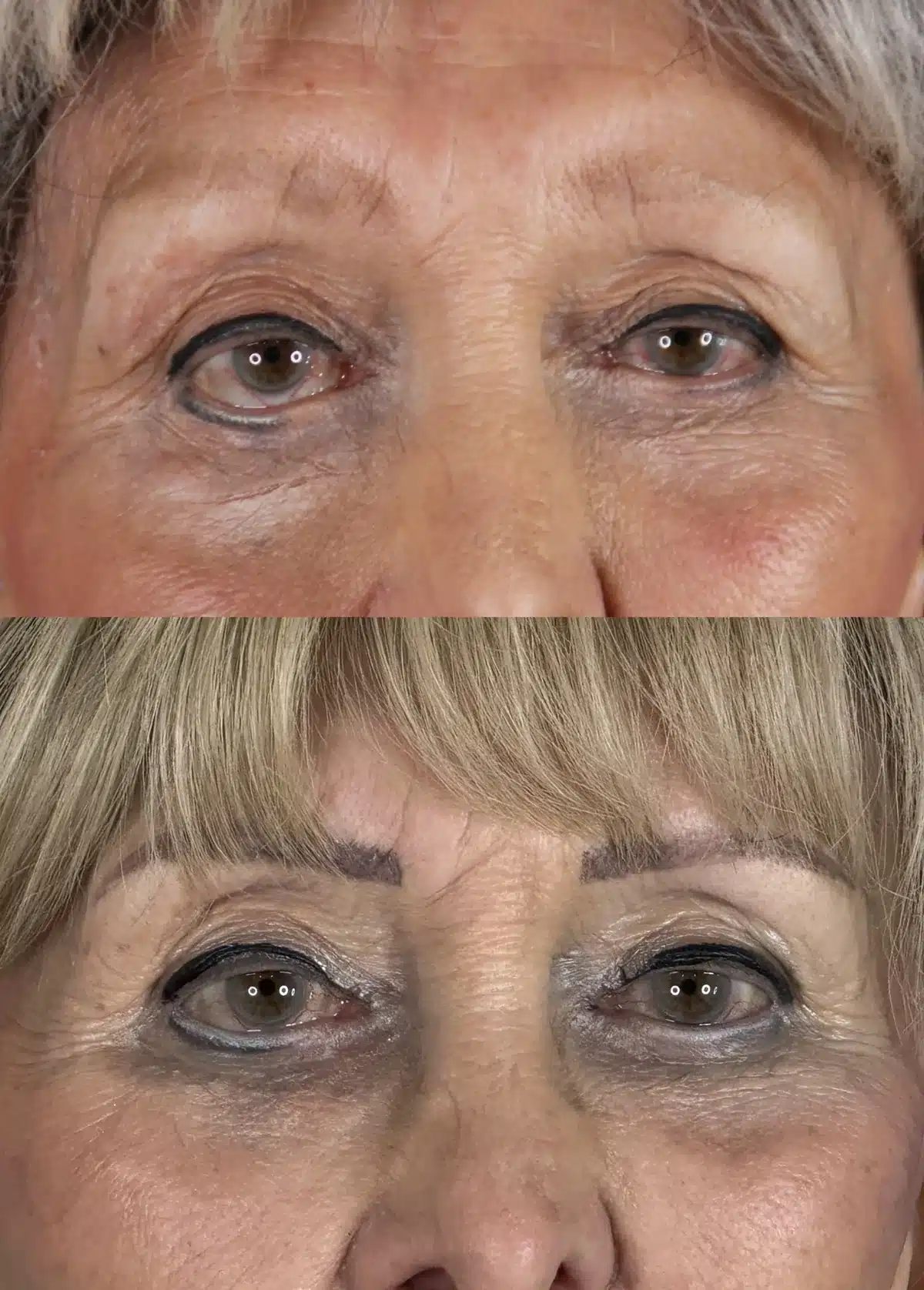 Upper blepharoplasty before and after, eyes open &mdash; before on top, after below; the excess upper-lid skin is gone and the lid platform is visible again