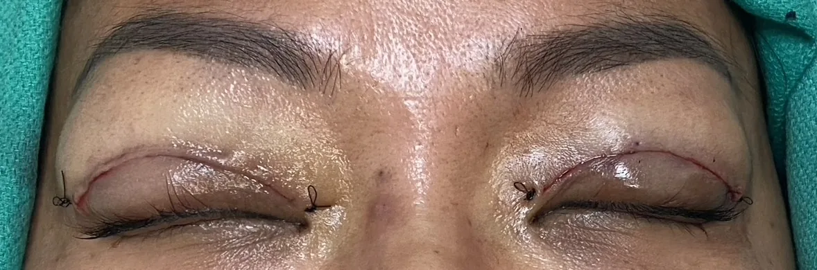 Upper blepharoplasty incisions immediately after surgery, both eyes closed &mdash; clinical photo from Troell Cosmetic Surgery, Las Vegas