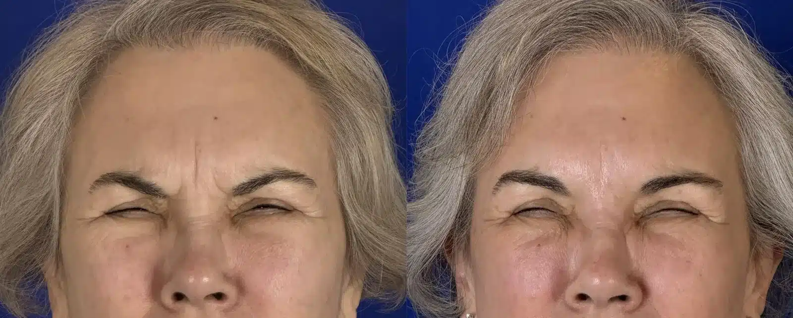 Antes y despu&eacute;s de Xeomin, vista frontal &mdash; las l&iacute;neas del entrecejo y de la frente se ven m&aacute;s suaves. Paciente real en Las Vegas.