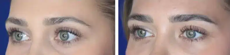 Bellafill under-eye (tear trough) before and after, oblique view &mdash; the hollow beneath the eye is shallower after Bellafill by Dr. Robert J. Troell in Las Vegas. Actual patient; individual results vary.
