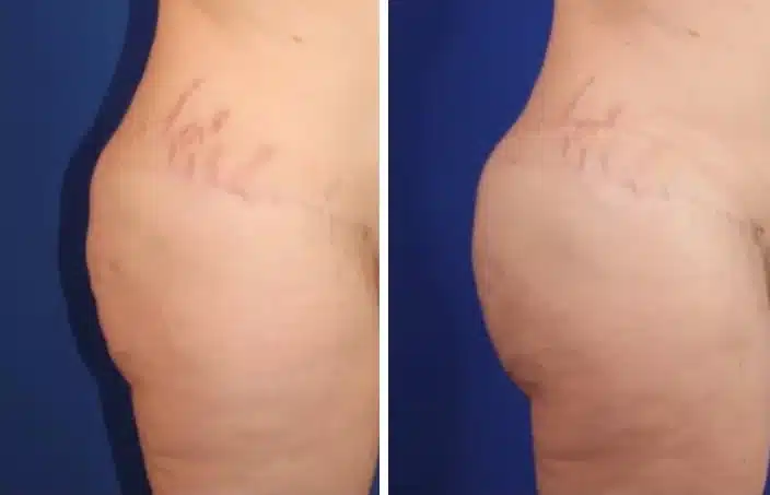 Brazilian butt lift before and after, left profile view &mdash; a woman's buttock before, fuller and rounder with more projection after fat transfer to the buttocks by Dr. Robert J. Troell, Las Vegas. Actual patient; individual results vary.