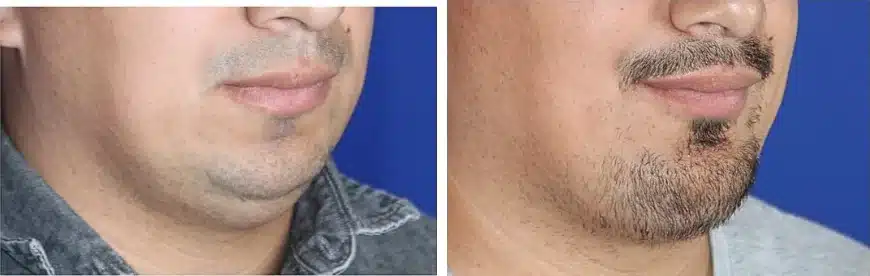 Chin implant before & after, right oblique view &mdash; Patient 6 &mdash; Chin Implant