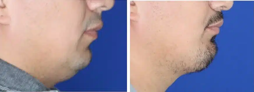 Chin implant before and after, right profile &mdash; a bearded male patient's receding chin and soft chin-to-neck line before, stronger forward chin projection and a sharper chin-to-neck angle after chin implant surgery by Dr. Robert J. Troell, Las Vegas. Actual patient; individual results vary.