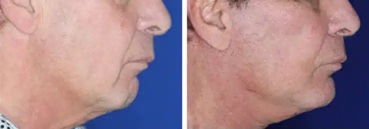 Chin implant before & after, right profile &mdash; Patient 4 &mdash; Chin Implant