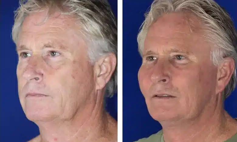 Facelift before & after, left three-quarter view &mdash; Patient 3 &mdash; Facelift & Neck Lift with Jowl Liposuction & Midface Implants