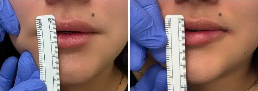 Lip filler before and after, lips measured against a ruler &mdash; the upper and lower lip show more volume after lip filler by Dr. Robert J. Troell in Las Vegas. Actual patient; individual results vary.
