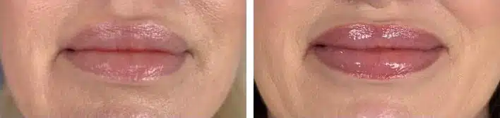 Rellenos de labios antes y despu&eacute;s, primer plano frontal &mdash; el labio superior y el inferior se ven m&aacute;s llenos y lisos tras el relleno de labios por el Dr. Robert J. Troell en Las Vegas. Paciente real; los resultados individuales var&iacute;an.