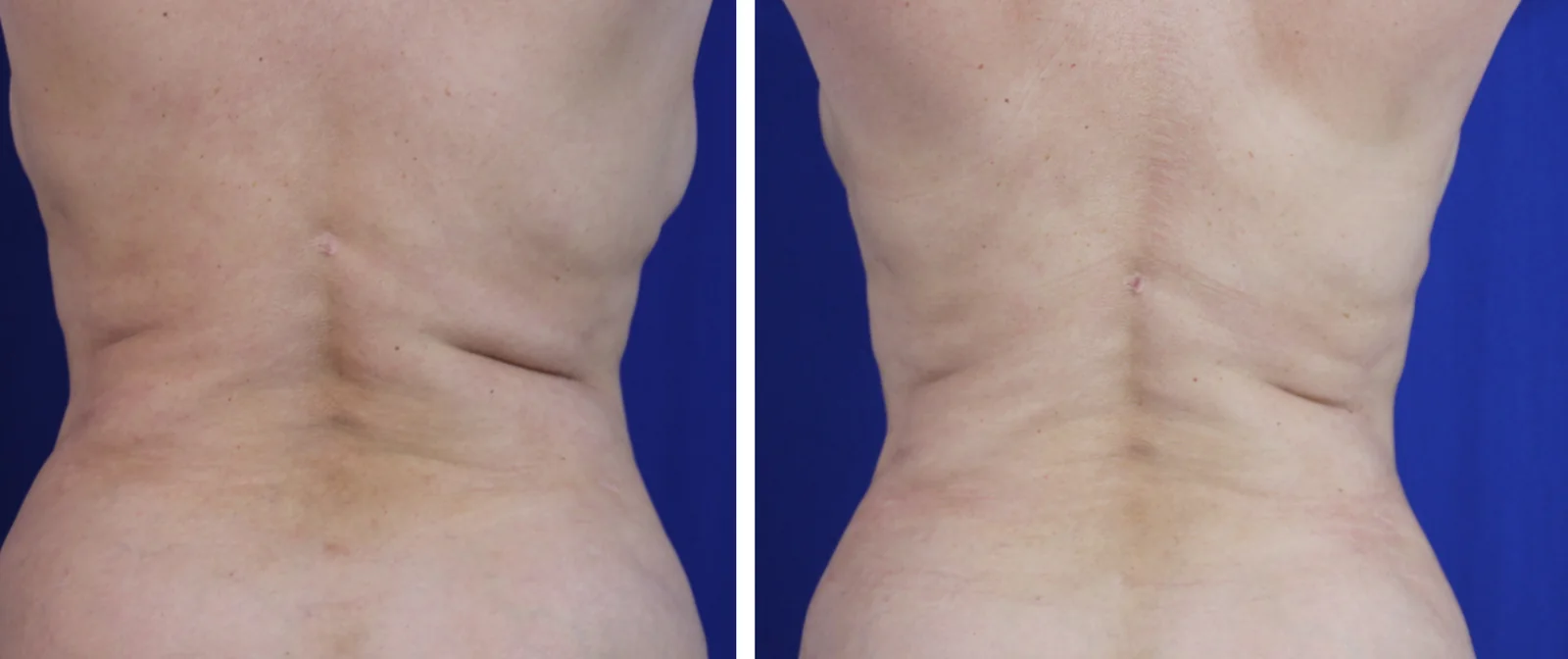 Liposuction before and after, back view &mdash; the lower back and flanks are smoother and more tapered after liposuction of the abdomen, flanks, and lower back by Dr. Robert J. Troell in Las Vegas