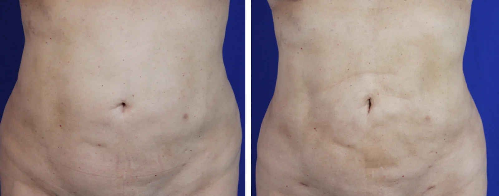 Liposuction before and after, front view &mdash; the abdomen is flatter and the waistline narrower after liposuction of the abdomen, flanks, and lower back by Dr. Robert J. Troell in Las Vegas