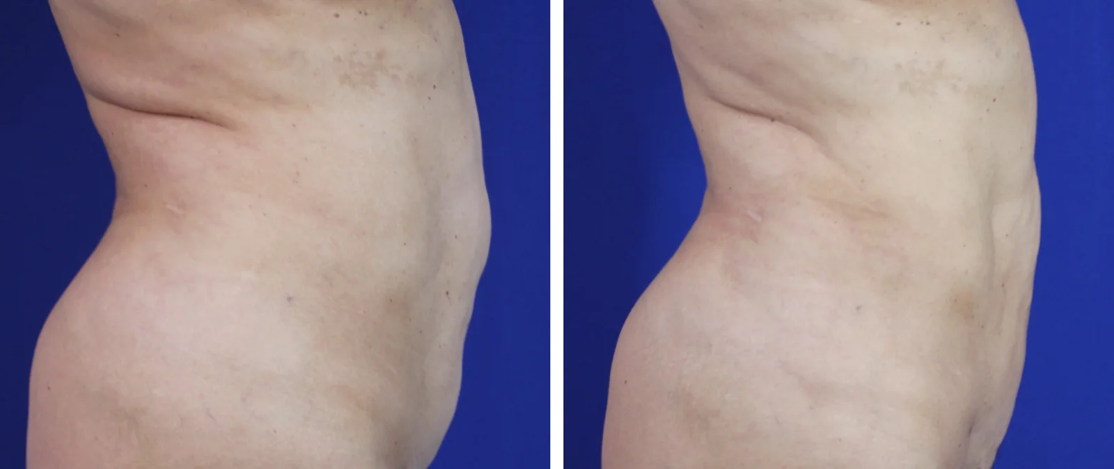 Liposuction before and after, side view &mdash; the abdominal profile is flatter and the flank fullness reduced after liposuction of the abdomen, flanks, and lower back by Dr. Robert J. Troell in Las Vegas