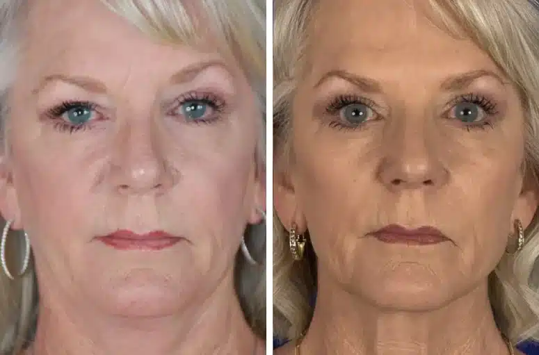 Midface implants before and after, front view &mdash; a woman's flattened midface regains cheek volume and a smoother contour after midface implant placement by Dr. Robert J. Troell in Las Vegas. Actual patient; individual results vary.