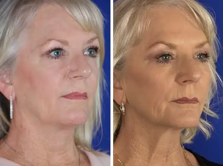 Midface implants before & after, right three-quarter view &mdash; Patient 8 &mdash; Midface Implants