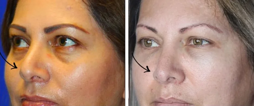 Rhinoplasty before and after, left three-quarter view &mdash; a woman's nasal tip before, a more refined tip after rhinoplasty by Dr. Robert J. Troell, Las Vegas; arrows mark the nasal tip. Actual patient; individual results vary.