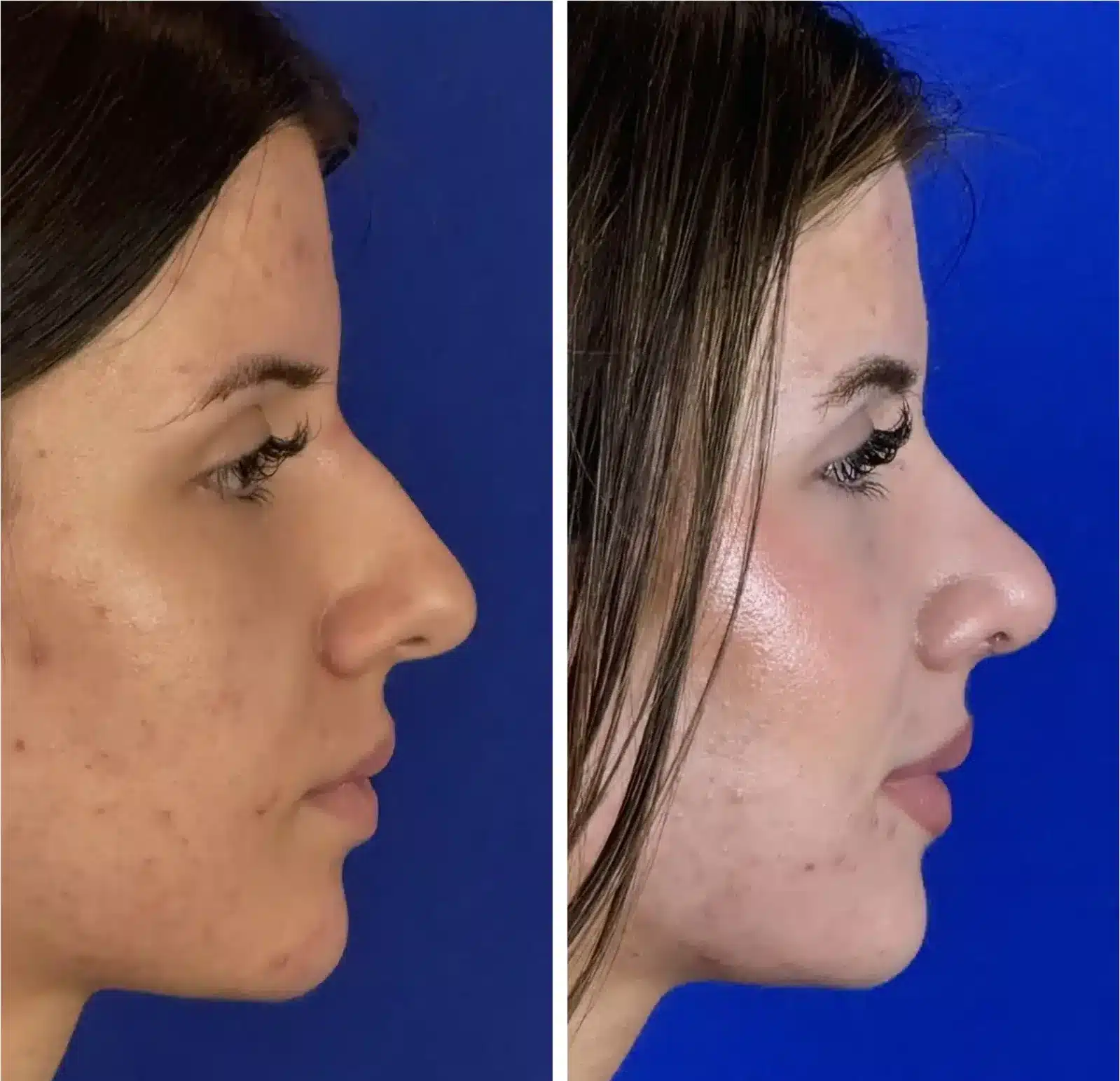 Rhinoplasty before & after, right profile &mdash; Patient 10 &mdash; Profile Rhinoplasty