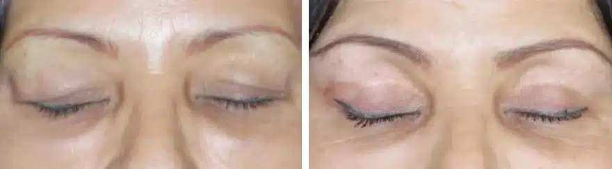 Upper blepharoplasty before & after, eyes closed &mdash; Patient 17 &mdash; Upper Blepharoplasty
