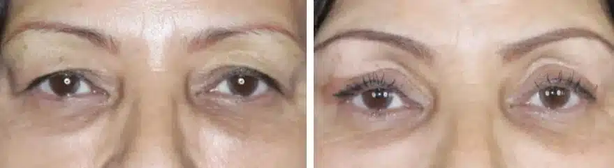 Blefaroplastia superior antes y despu&eacute;s, vista frontal con los ojos abiertos &mdash; los p&aacute;rpados superiores pesados y ca&iacute;dos de una mujer cubren la l&iacute;nea de las pesta&ntilde;as antes, y despu&eacute;s muestran un pliegue palpebral visible y una mirada m&aacute;s abierta tras la cirug&iacute;a de p&aacute;rpados superiores realizada por el Dr. Robert J. Troell en Las Vegas. Paciente real; los resultados individuales var&iacute;an.