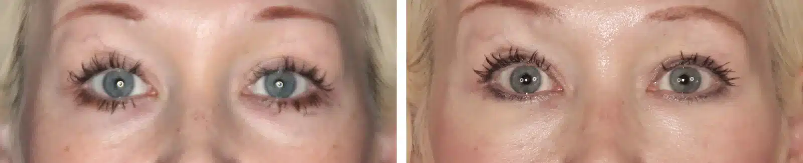 Bellafill under-eye (tear trough) before and after, front view &mdash; the shadowed hollow beneath each eye is shallower after Bellafill by Dr. Robert J. Troell in Las Vegas. Actual patient; individual results vary.