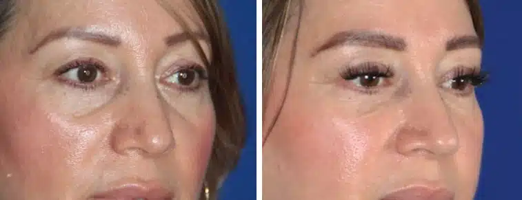 Bellafill under-eye (tear trough) before and after, right three-quarter view &mdash; the crescent-shaped hollow beneath the eye is shallower after Bellafill by Dr. Robert J. Troell in Las Vegas. Actual patient; individual results vary.
