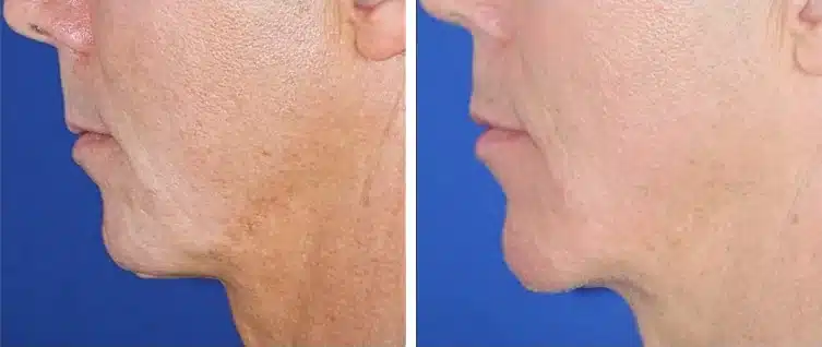 Chin implant before and after, left profile &mdash; a mature patient's receding chin and soft chin-to-neck line before, forward chin projection and a sharper chin-to-neck angle after chin implant surgery by Dr. Robert J. Troell, Las Vegas. Actual patient; individual results vary.