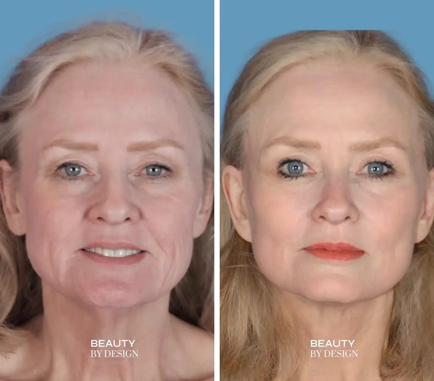 Facelift before & after, front view &mdash; Patient 8 &mdash; Facelift