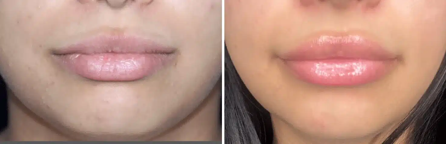 Rellenos de labios antes y despu&eacute;s, vista frontal tras una sola jeringa &mdash; el labio superior y el inferior se ven m&aacute;s llenos y con el borde definido tras el relleno de labios por el Dr. Robert J. Troell en Las Vegas. Paciente real; los resultados individuales var&iacute;an.