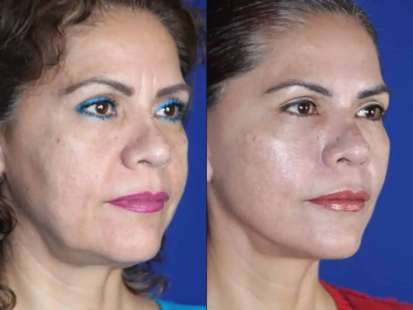 Submalar cheek implants before and after, right three-quarter view &mdash; a woman's flattened midface below the cheekbones regains volume and a smoother cheek contour after submalar implant placement performed with a facelift and neck lift by Dr. Robert J. Troell in Las Vegas. Actual patient; individual results vary.