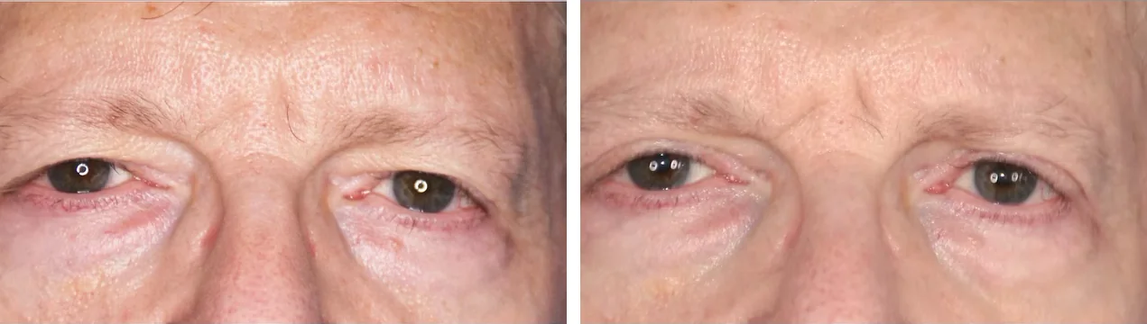 Upper and lower blepharoplasty before and after, front view with eyes open &mdash; a man&rsquo;s loose upper-lid skin folding toward the lash line and puffy, loose lower lids before; more open upper lids and a smoother lower-lid contour after upper and lower eyelid surgery by Dr. Robert J. Troell, Las Vegas. Actual patient; individual results vary.